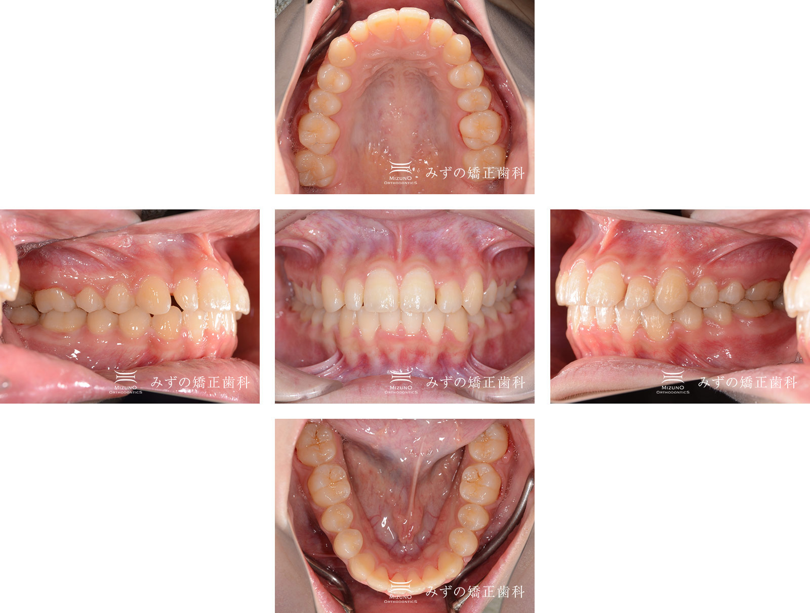 ガタガタの歯 症例画像