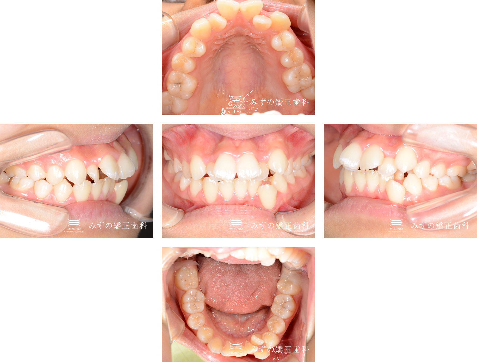ガタガタの歯 症例画像