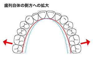 歯列自体の側方への拡大
