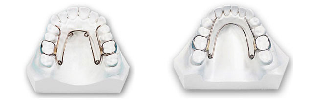 歯列の幅を横に広げる装置